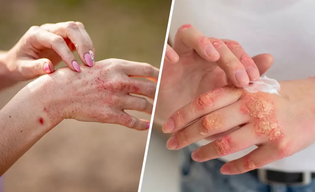 Psoriasis and Eczema Treatment