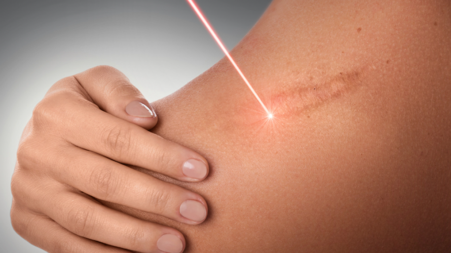 Burn Scar Management