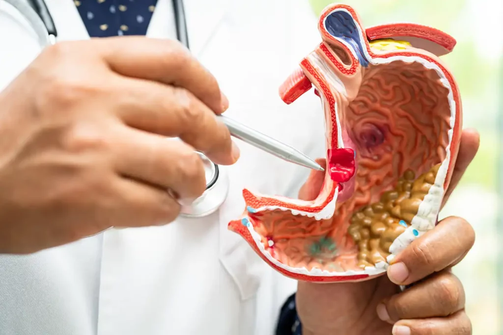 Gallbladder Removal Surgery