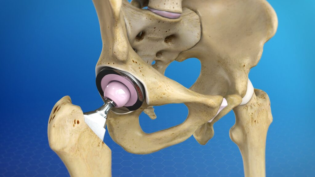 Hip Replacement Surgery